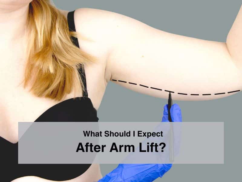 What Should I Expect After Arm Lift