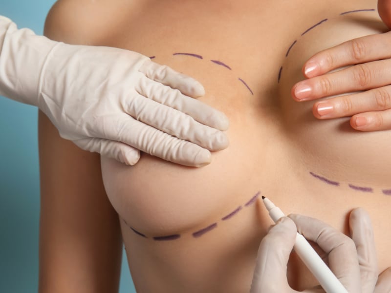 What You Need To Know About Breast Lift Scars