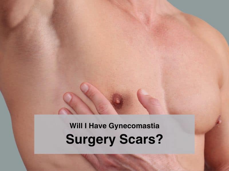 Will I Have Gynecomastia Surgery Scars?