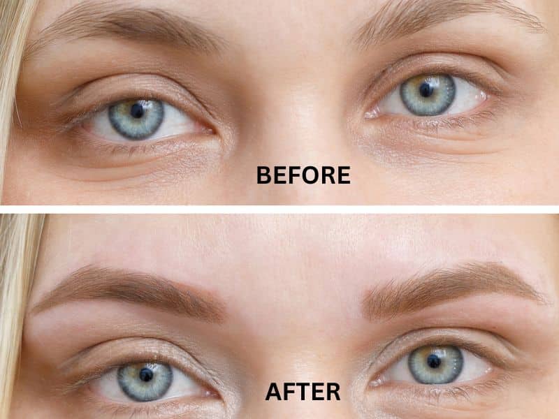 before and after direct brow lift scars