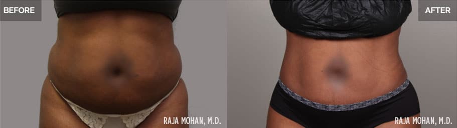 High Definition Liposuction Before and After Arlington