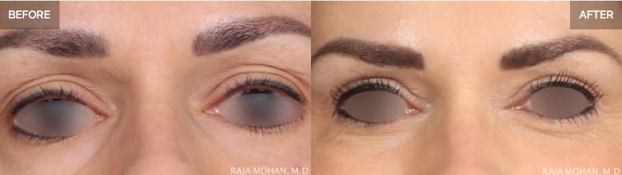Blepharoplasty Dallas