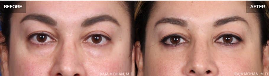 Blepharoplasty Dallas