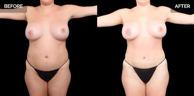 Liposuction Dallas