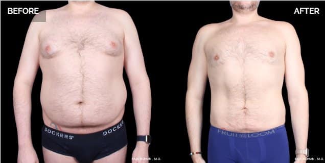 Liposuction Dallas