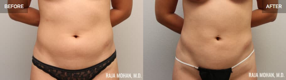 Liposuction Before and After Addison