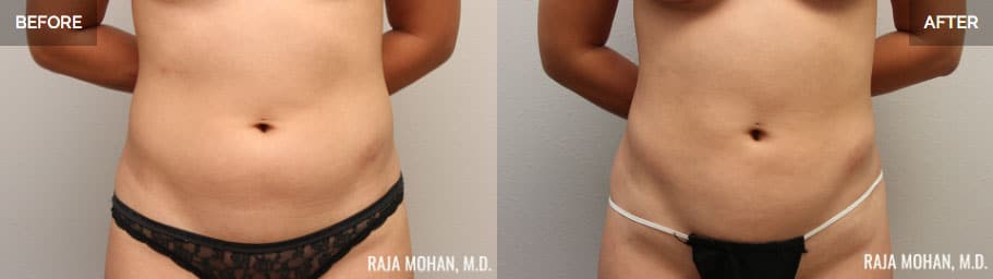 Liposuction Before and After Aledo