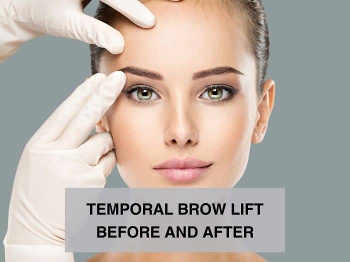 temporal brow lift before and after