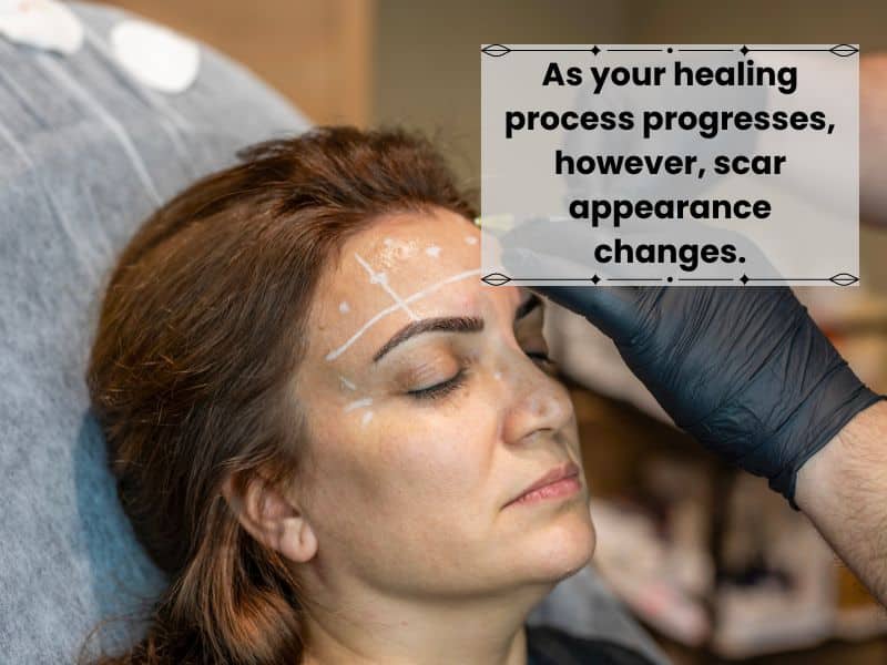 temporal brow lift scars