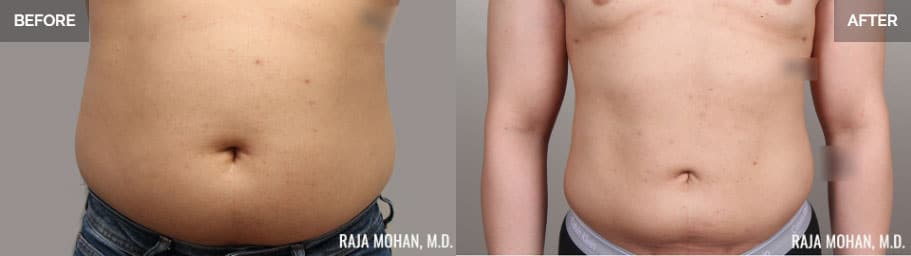 Tumescent Liposuction Before and After Addison