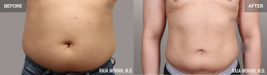 Tumescent Liposuction Before and After Crowley