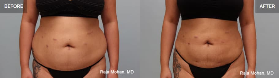  Vaser Liposuction Before and After Arlington