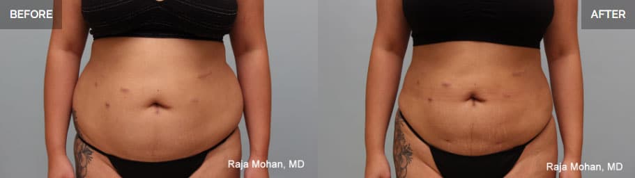 Vaser Liposuction Before and After Geo City